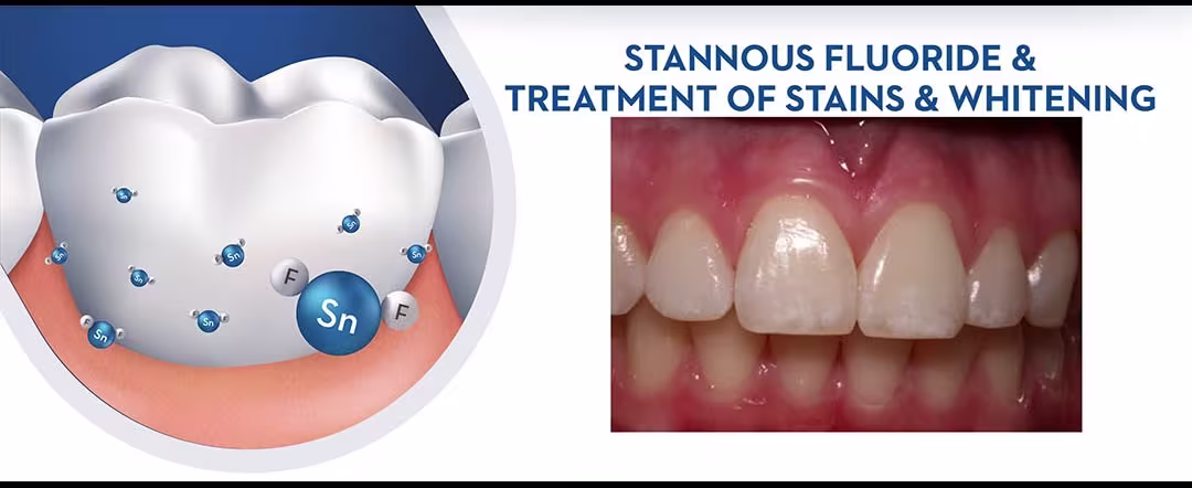 Stannous Fluoride and Treatment of Stains and Whitening
