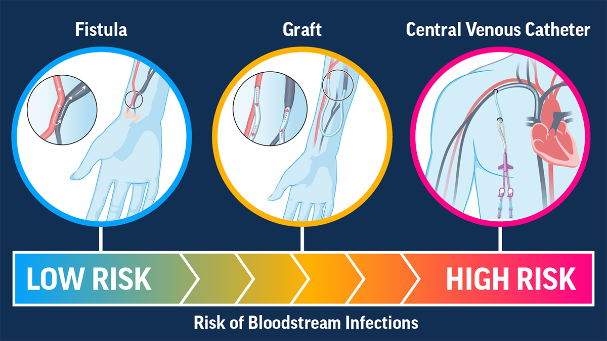 Risk of Bloodstream Infections: Low Risk Fistula, Medium Risk Graft, High Risk Central Venous Catheter