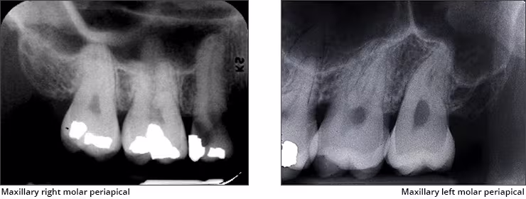 Maxillary Posterior Landmarks - Figure 1