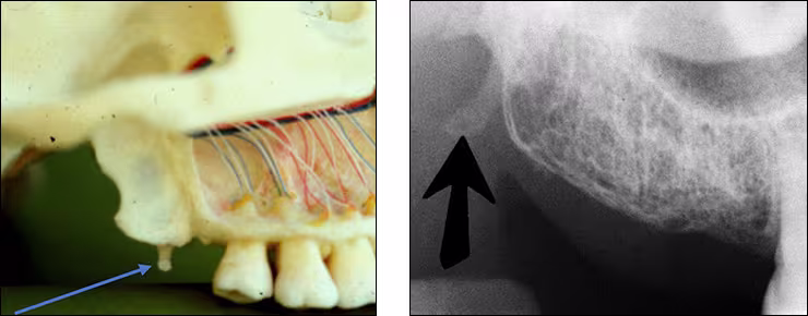 Maxillary Posterior Landmarks - Figure 8