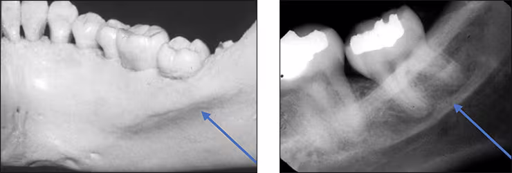 Mandibular Posterior Landmarks - Figure 3