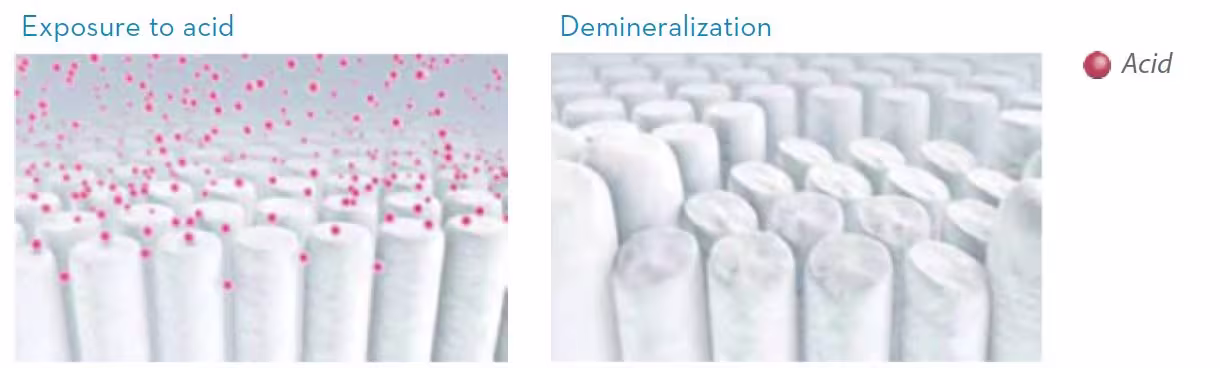 Demineralization associated with dental erosion