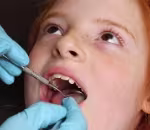 What Causes Cavities