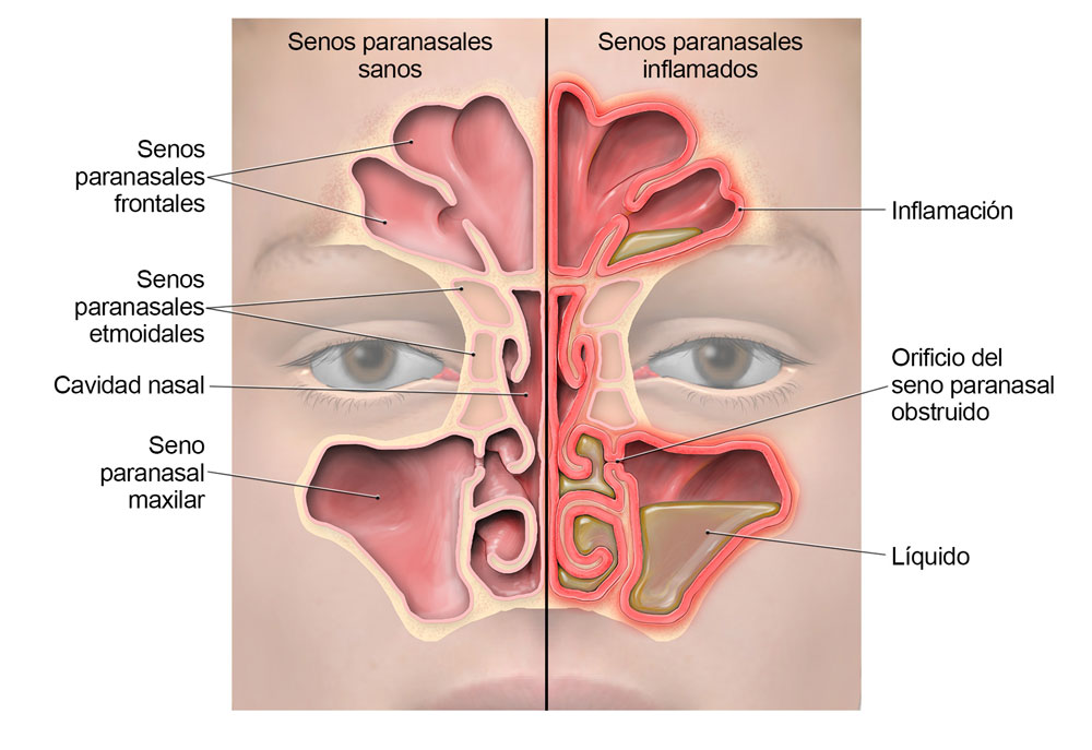 Diagrama de la anatom&iacute;a de los senos paranasales que muestra d&oacute;nde ocurre la inflamaci&oacute;n y d&oacute;nde se acumula el l&iacute;quido durante la sinusitis.